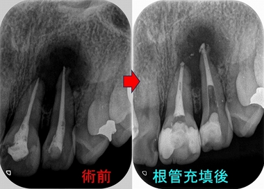 間違った根管治療で大きな根尖病変（膿） - EE DENTAL_Blog